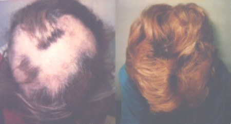 treatment of hair loss due to alopecia areata
