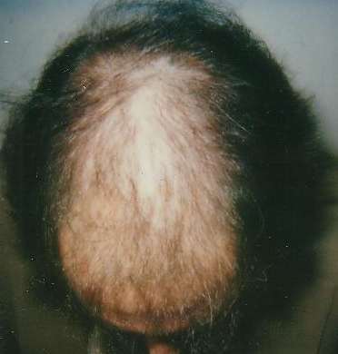 Hair-loss treatment start