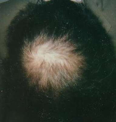 regrowth after treatment