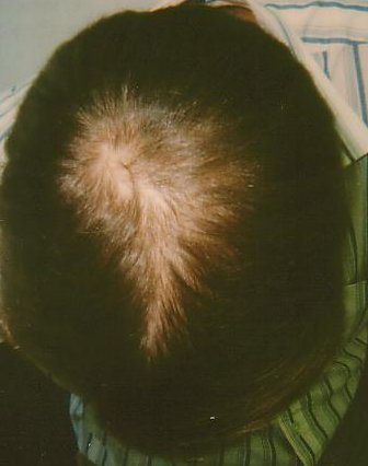 Hair-loss, after treatment