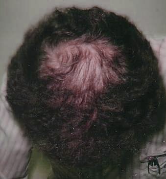 Hair loss, post treatment
