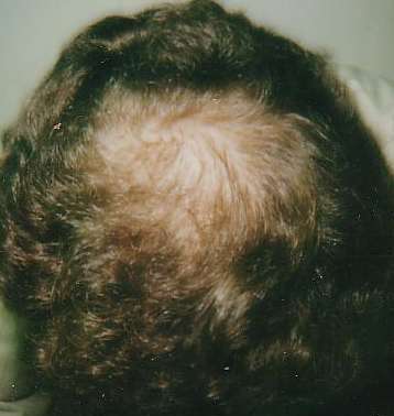 Hair regrowth pictures--before